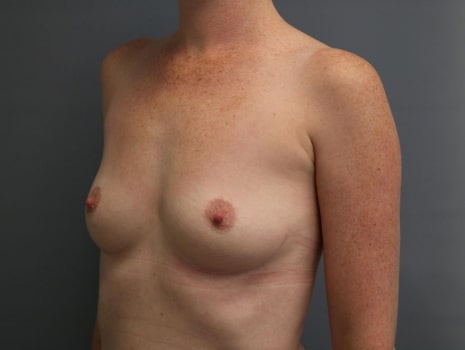 Before Image: Mommy Makeover - left-front-oblique