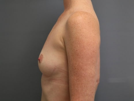 Before Image: Mommy Makeover - left-side