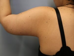 After Image: Arm Lift