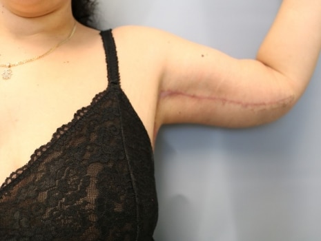 After Image: Arm Lift - front