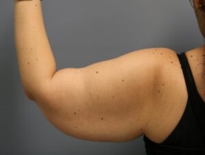 Before Image: Arm Lift