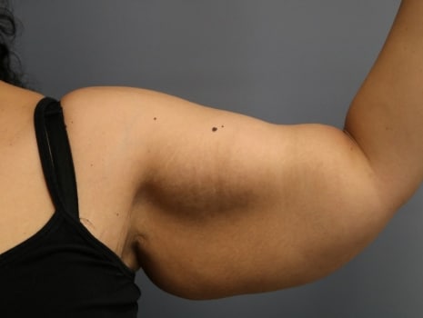 Before Image: Arm Lift - front
