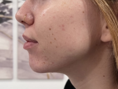 After Image: Chin - left-side