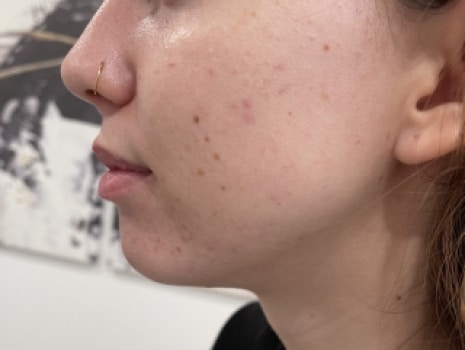 Before Image: Chin - left-side