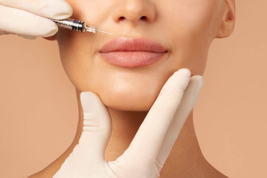 Woman with plump, full lips getting lip filler injections in Huntington Beach, CA