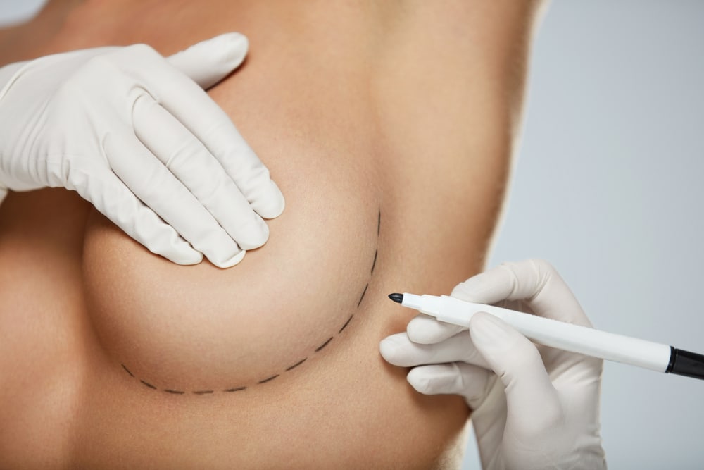 Surgeon marking a woman's breast where incisions will go for breast lift in Huntington Beach, CA