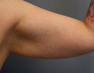 Before Arm Lift Surgery Huntington Beach CA