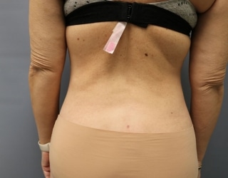 After Liposuction Huntington Beach CA